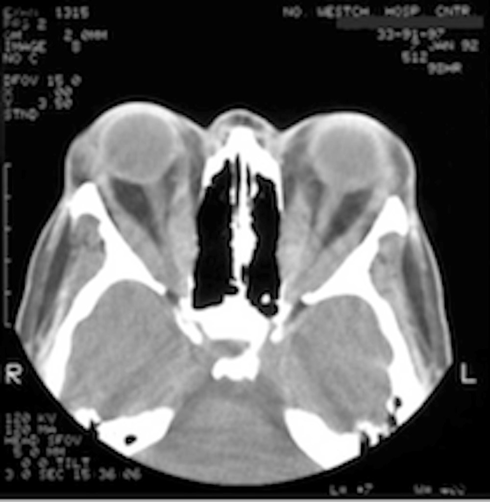 Thyroid Eye Disease X-Ray Fig.2