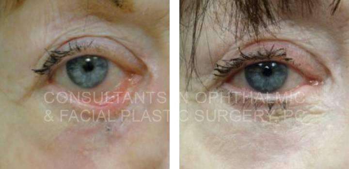 Ectropion Repair - Consultants in Ophthalmic and Facial Plastic Surgery