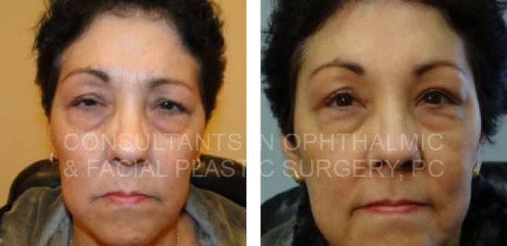 Bilateral Endoscopic Forehead Lift, Ptosis Repair of Both Upper Lids - Consultants in Ophthalmic and Facial Plastic Surgery