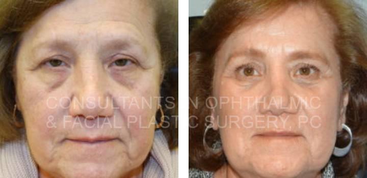 Bilateral Endoscopic Forehead Lift, Blepharoplasty Both Lower Eyelids, Excision Lesion Right Lower Eyelid - Consultants in Ophthalmic and Facial Plastic Surgery