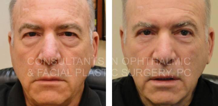 Blepharoplasty Both Upper & Lower Eyelids, Ptosis Repair Both Upper Eyelids - Consultants in Ophthalmic and Facial Plastic Surgery
