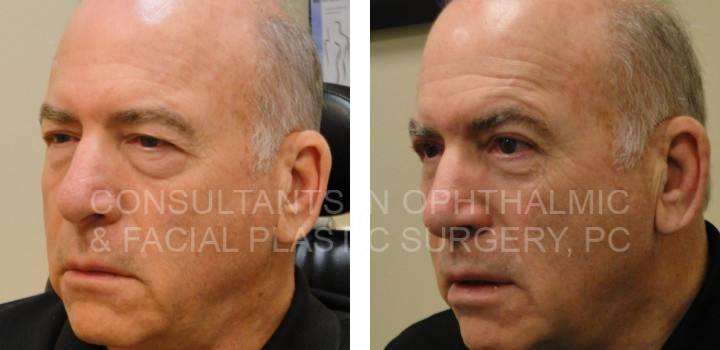 Blepharoplasty Both Upper & Lower Eyelids, Ptosis Repair Both Upper Eyelids - Consultants in Ophthalmic and Facial Plastic Surgery
