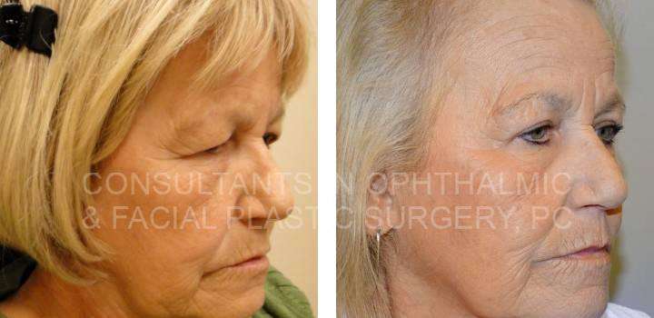 Blepharoplasty & Ptosis Repair Both Upper Eyelids - Consultants in Ophthalmic and Facial Plastic Surgery