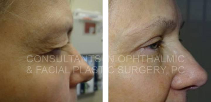 Blepharoplasty & Ptosis Repair Both Upper Eyelids - Consultants in Ophthalmic and Facial Plastic Surgery