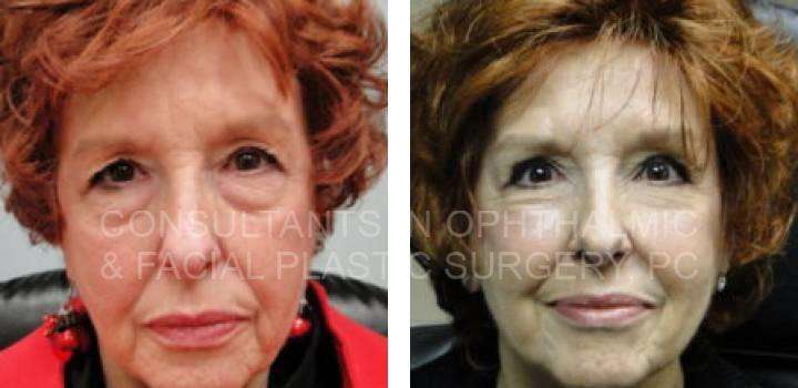 Blepharoplasty & Ptosis Repair Both Upper Eyelids, Blepharoplasty Both Lower Eyelids - Consultants in Ophthalmic and Facial Plastic Surgery