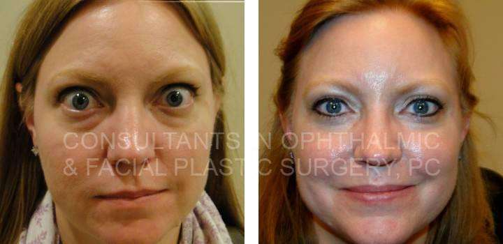Retraction Repair Both Upper Eyelids - Consultants in Ophthalmic and Facial Plastic Surgery