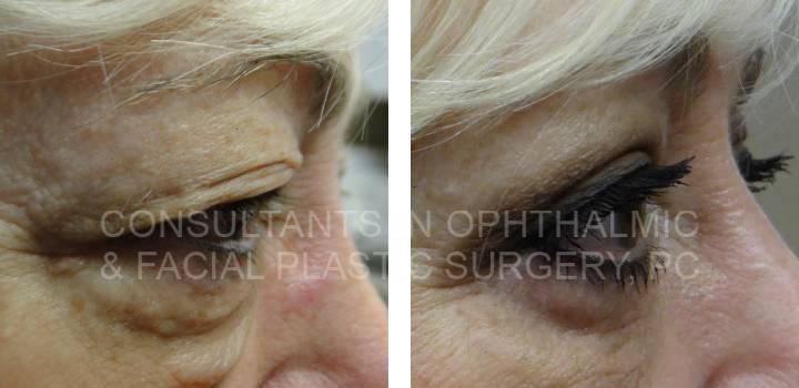 Blepharoplasty Both Upper Eyelids, Ptosis Repair Left Upper Eyelid, and Blepharoplasty Both Lower Eyelids - Consultants in Ophthalmic and Facial Plastic Surgery
