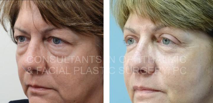 Ptosis Repair of Both Upper Eyelids, Lower Eyelid Blepharoplasty & Co2 Laser Both Lower Eyelids - Consultants in Ophthalmic and Facial Plastic Surgery