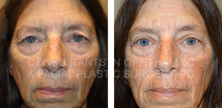 Upper Eyelid Blepharoplasty for Both Upper Lids - Consultants in Ophthalmic and Facial Plastic Surgery