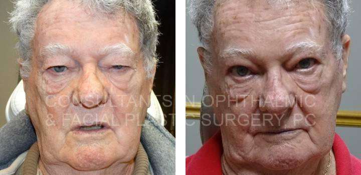 Blepharoplasty Both Upper Eyelids, Repair Ptosis Left Upper Eyelid, Remove Lesion Left Eyelid - Consultants in Ophthalmic and Facial Plastic Surgery
