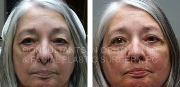 Blepharoplasty Both Upper Eyelids, Blepharoplasty Both Lower Lids, Excision Mass Left Lower Lid - Consultants in Ophthalmic and Facial Plastic Surgery
