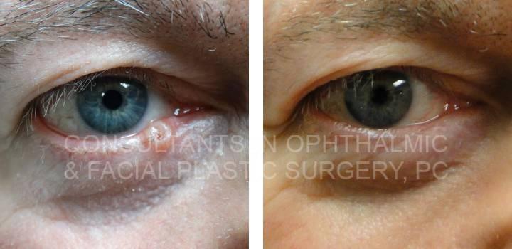 Excision Lesion Right Lower Eyelid - Consultants in Ophthalmic and Facial Plastic Surgery