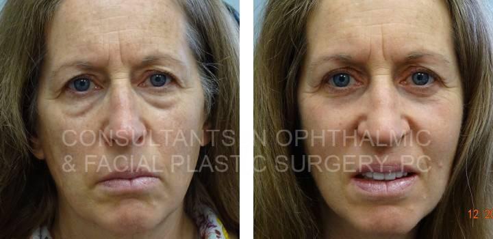 Blepharoplasty Both Upper Eyelids, Blepharoplasty Both Lower Eyelids & Co2 Laser Both Lower Eyelids - Consultants in Ophthalmic and Facial Plastic Surgery