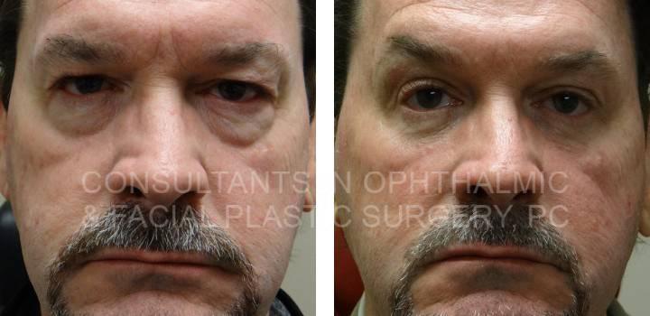 Blepharoplasty Both Lower Eyelids and Repair Ptosis Both Upper Eyelids - Consultants in Ophthalmic and Facial Plastic Surgery