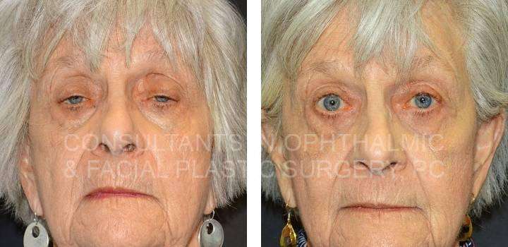 Ptosis Repair Both Upper Lids - Consultants in Ophthalmic and Facial Plastic Surgery