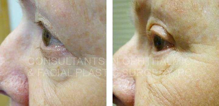 Upper Eyelid Blepharoplasty and Excision Lesion Right Upper Lid - Consultants in Ophthalmic and Facial Plastic Surgery