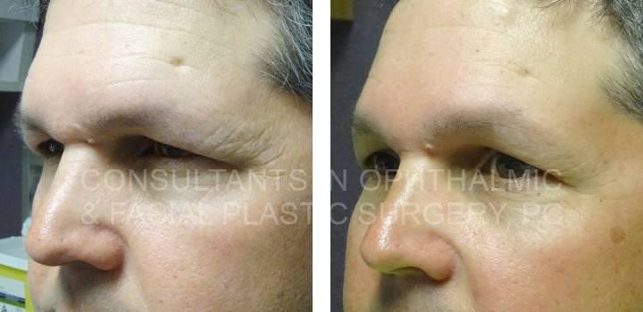 Bilateral Endoscopic Forehead Lift - Consultants in Ophthalmic and Facial Plastic Surgery
