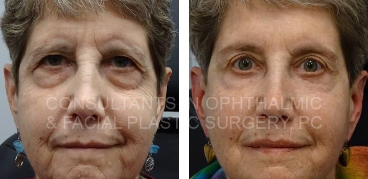 Bilateral Endoscopic Forehead Lift, Blepharoplasty Both Upper Lids, Excision Herniated Orbital Fat Both Lower Lids with Co2 Laser - Consultants in Ophthalmic and Facial Plastic Surgery