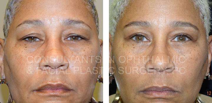Upper Eyelid Ptosis Repair, Blepharoplasty Both Upper Lids - Consultants in Ophthalmic and Facial Plastic Surgery