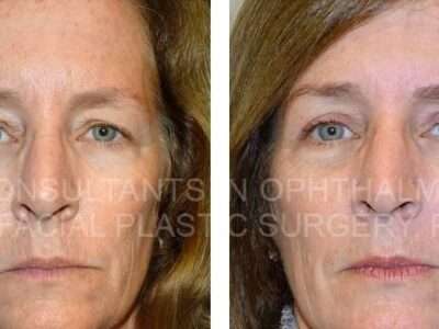 Blepharoplasty Both Upper Lids, Ptosis Repair Both Upper Lids, Excision Lesion Left Upper Lid - Consultants in Ophthalmic and Facial Plastic Surgery