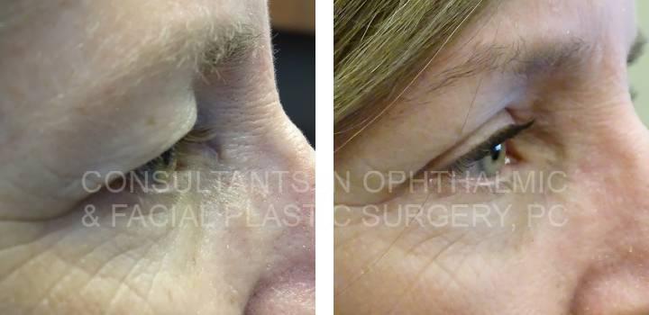 Blepharoplasty Both Upper Lids, Ptosis Repair Both Upper Lids, Excision Lesion Left Upper Lid - Consultants in Ophthalmic and Facial Plastic Surgery