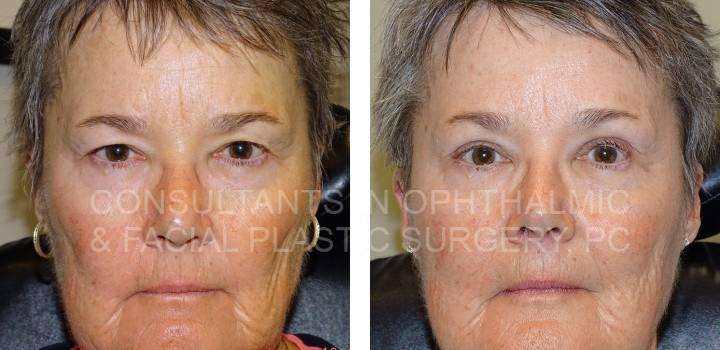 Upper Eyelid Blepharoplasty Both Upper Lids with Crease Elevation - Consultants in Ophthalmic and Facial Plastic Surgery