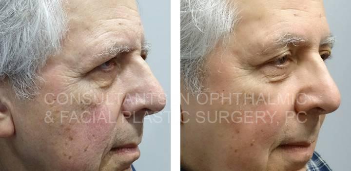 Upper Eyelid Blepharoplasty Both Upper Lids with Crease Elevation - Consultants in Ophthalmic and Facial Plastic Surgery