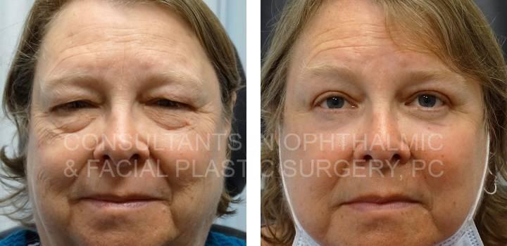 Blepharoplasty Both Upper Lids, Ptosis Repair Both Upper Lids, Excision Herniated Orbital Fat Both Lower Lids with Co2 Laser - Consultants in Ophthalmic and Facial Plastic Surgery
