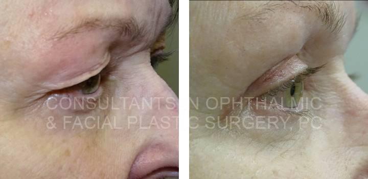 Blepharoplasty Both Upper Lids - Consultants in Ophthalmic and Facial Plastic Surgery
