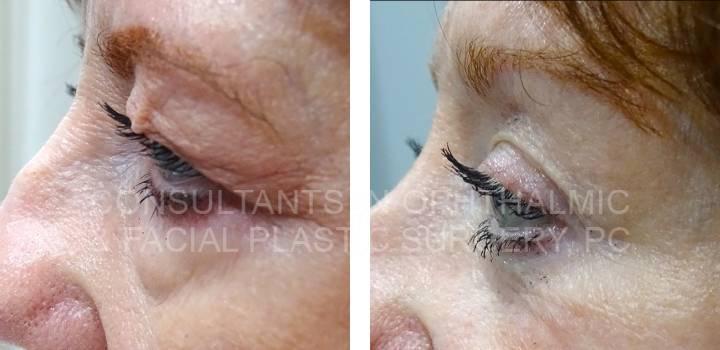 Bilateral Endoscopic Forehead Lift, Ptosis Repair Both Upper Lids, Excision Herniated Orbital Fat Both Lower Lids with Co2 Laser - Consultants in Ophthalmic and Facial Plastic Surgery