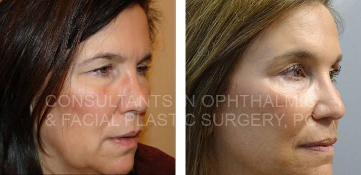 Bilateral Endoscopic Forehead Lift - Consultants in Ophthalmic and Facial Plastic Surgery