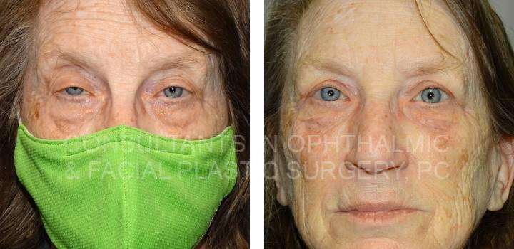 Both Upper Lids Ptosis Repair - Consultants in Ophthalmic and Facial Plastic Surgery