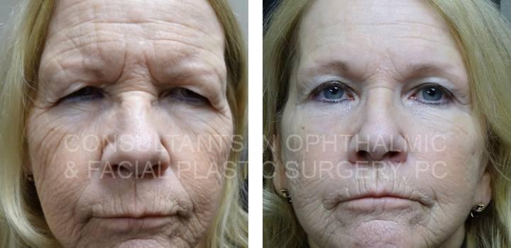 Bilateral Endoscopic Forehead Lift, Blepharoplasty Both Upper Lids - Consultants in Ophthalmic and Facial Plastic Surgery