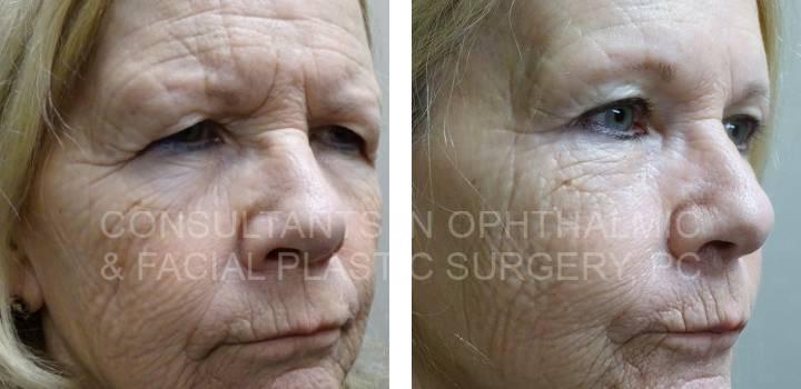 Bilateral Endoscopic Forehead Lift, Blepharoplasty Both Upper Lids - Consultants in Ophthalmic and Facial Plastic Surgery