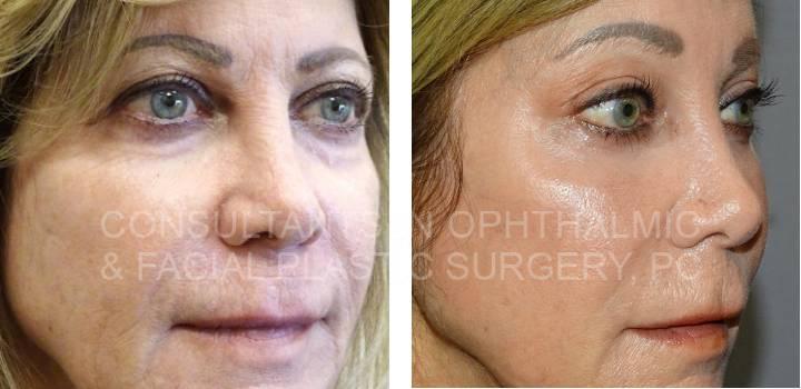 Blepharoplasty Both Upper Lids, Excision Herniated Orbital Fat Both Lower Lids with Co2 Laser, Bilateral Endoscopic Forehead Lift - Consultants in Ophthalmic and Facial Plastic Surgery