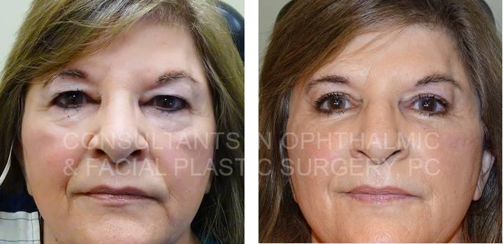 Blepharoplasty Both Upper Lids, Excision Herniated Orbital Fat Both Lower Lids with Co2 Laser - Consultants in Ophthalmic and Facial Plastic Surgery