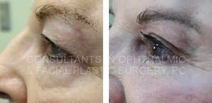 Blepharoplasty Both Upper Lids, Excision Herniated Orbital Fat Both Lower Lids with Co2 Laser - Consultants in Ophthalmic and Facial Plastic Surgery