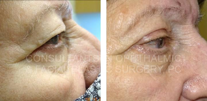 Blepharoplasty Both Upper Lids, Ptosis Repair Both Upper Lids - Consultants in Ophthalmic and Facial Plastic Surgery