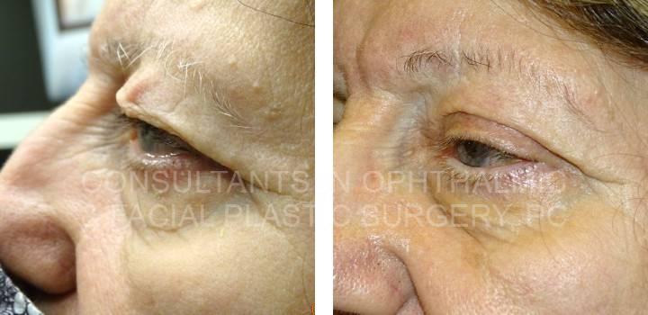 Blepharoplasty Both Upper Lids, Ptosis Repair Both Upper Lids - Consultants in Ophthalmic and Facial Plastic Surgery