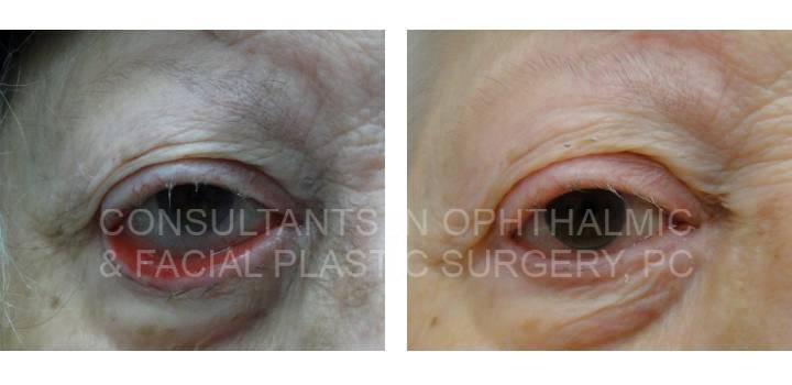 Ectropion Repair Right Lower Lid - Consultants in Ophthalmic and Facial Plastic Surgery