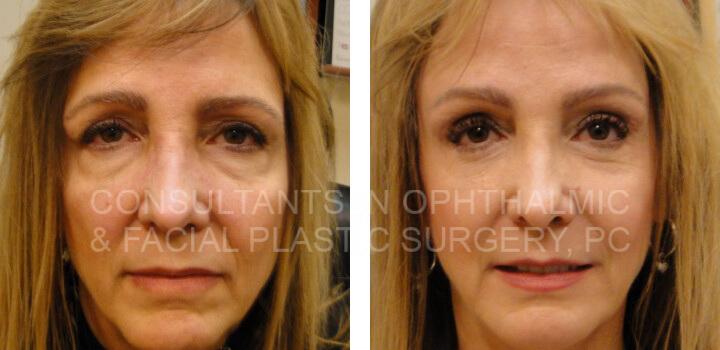 Bilateral Endoscopic Forehead Lift, Blepharoplasty Both Lower Eyelids, and Juvederm - Consultants in Ophthalmic and Facial Plastic Surgery