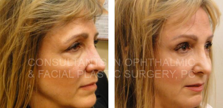 Bilateral Endoscopic Forehead Lift, Blepharoplasty Both Lower Eyelids, and Juvederm - Consultants in Ophthalmic and Facial Plastic Surgery