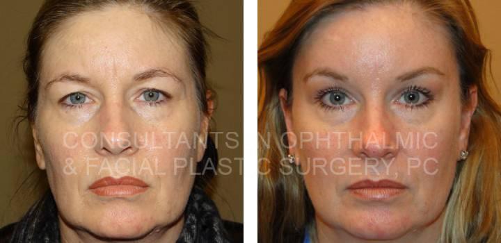 Bilateral Endoscopic Forehead Lift and Blepharoplasty Both Upper Eyelids - Consultants in Ophthalmic and Facial Plastic Surgery