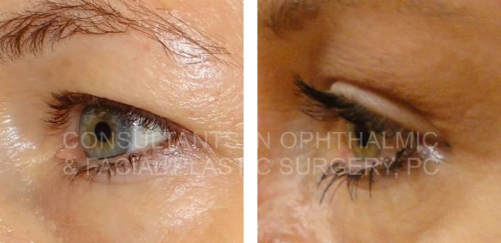 Bilateral Endoscopic Forehead Lift and Blepharoplasty Both Upper Eyelids - Consultants in Ophthalmic and Facial Plastic Surgery