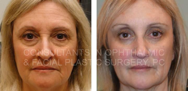 Bilateral Endoscopic Forehead Lift and Blepharoplasty Both Lower Eyelids - Consultants in Ophthalmic and Facial Plastic Surgery