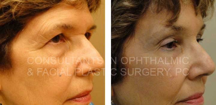 Bilateral Endoscopic Forehead Lift and Excision Lesion Right Cheek - Consultants in Ophthalmic and Facial Plastic Surgery