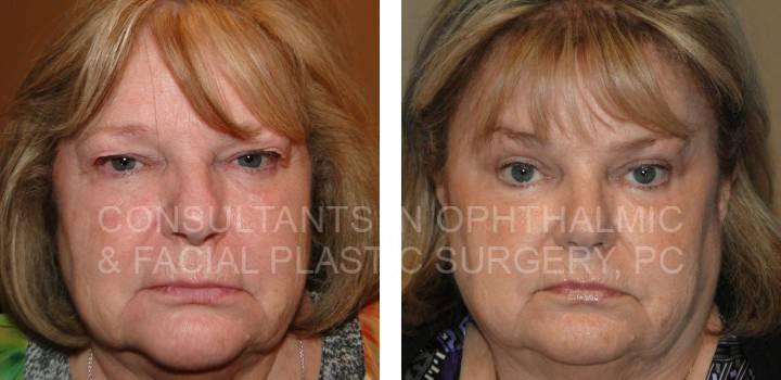 Bilateral Endoscopic Forehead Lift, Blepharoplasty and Ptosis Repair Both Upper Eyelids - Consultants in Ophthalmic and Facial Plastic Surgery