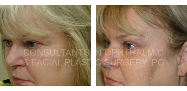 Bilateral Endoscopic Forehead Lift, Blepharoplasty and Ptosis Repair Both Upper Eyelids - Consultants in Ophthalmic and Facial Plastic Surgery