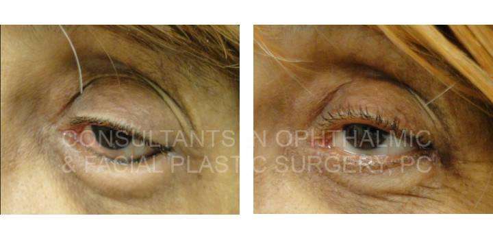 Entropion Repair Left Lower Eyelid - Consultants in Ophthalmic and Facial Plastic Surgery