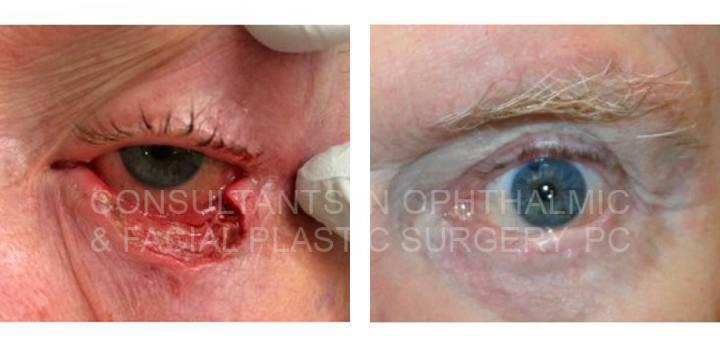 Left Lower Eyelid Hughes Procedure - Eye Surgery